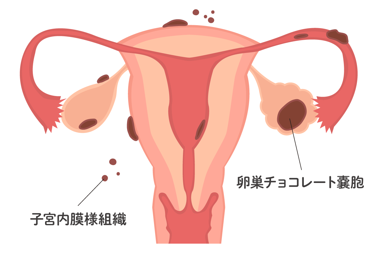 子宮内膜症