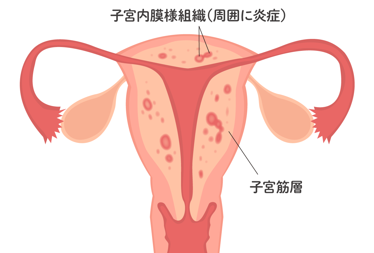 子宮腺筋症