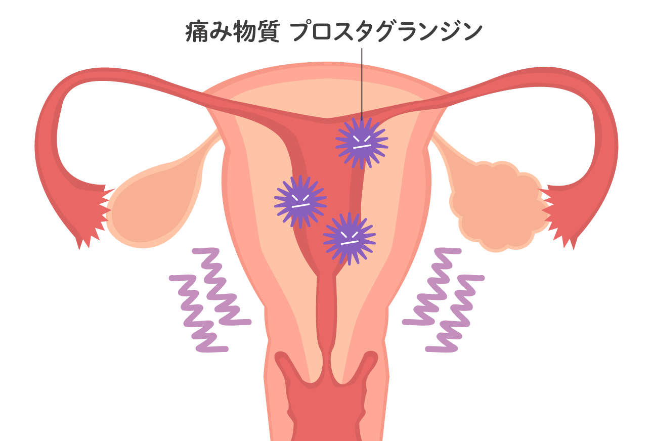 子宮筋腫