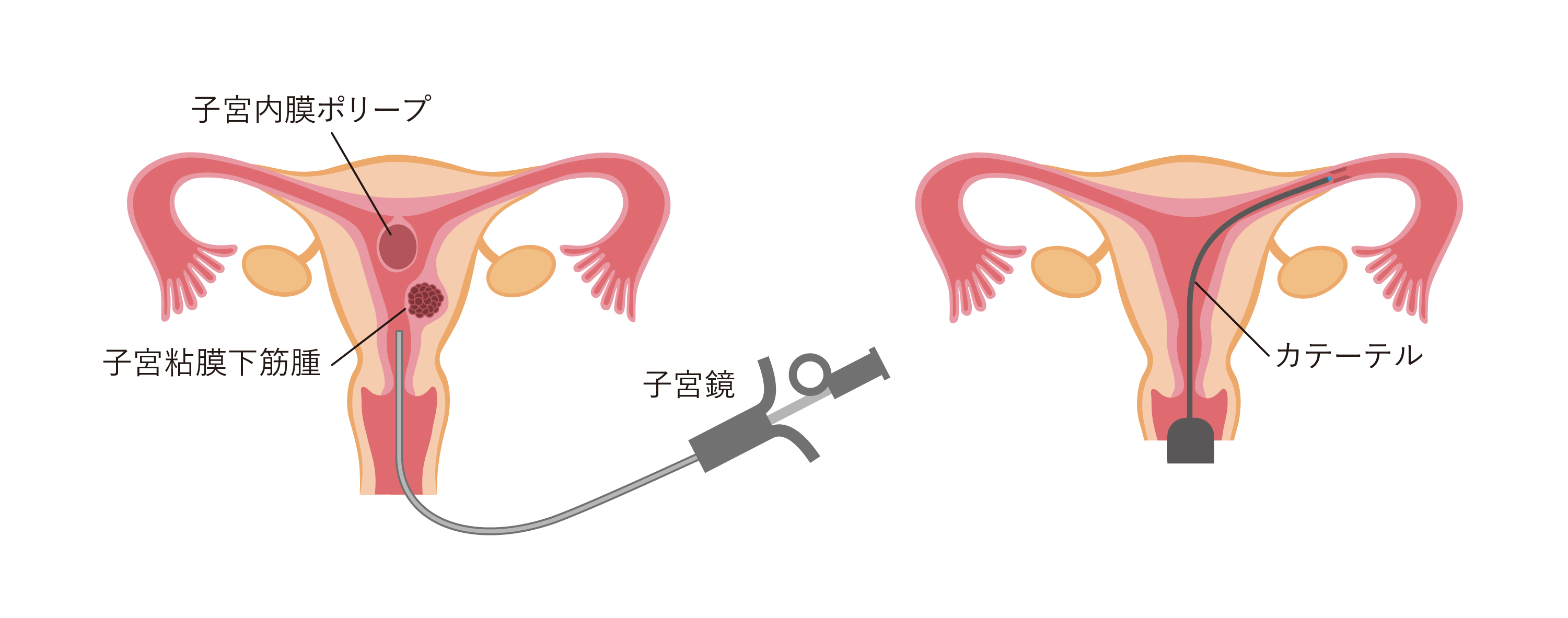 子宮鏡検査・通水検査