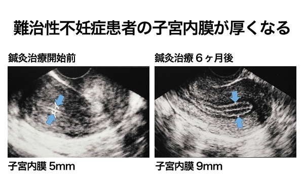 難治性不妊症患者の子宮内膜が厚くなる