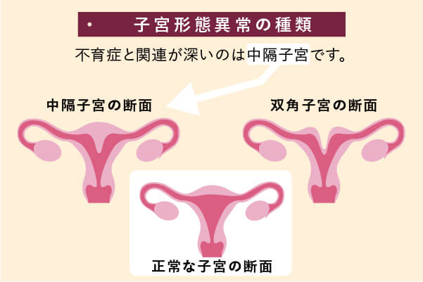 不育症の原因 子宮形態異常