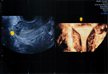 不育症検査 子宮形態検査