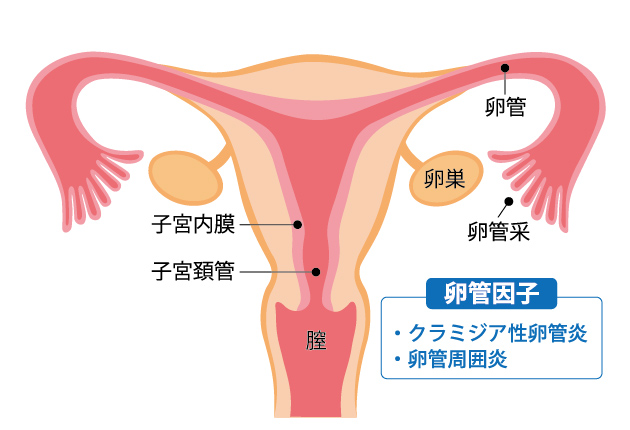 不妊症の原因(卵管因子)