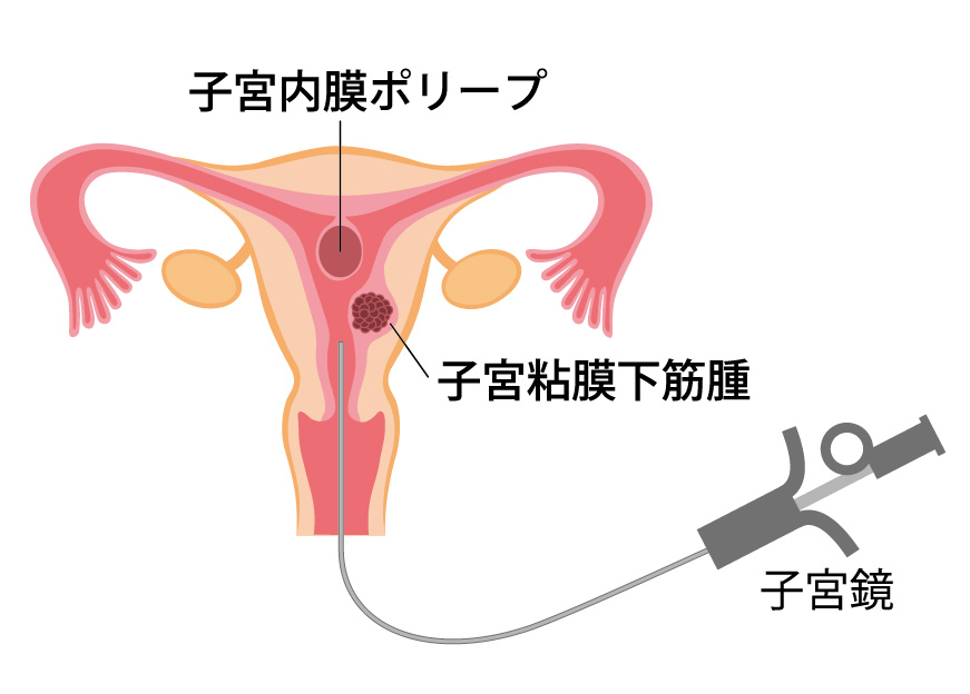 腫瘍外来(子宮鏡検査)：Tawara IVF Clinic：静岡市の不妊治療専門病院 俵IVFクリニック