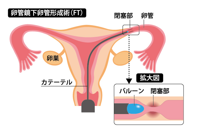 卵管鏡手術の実際