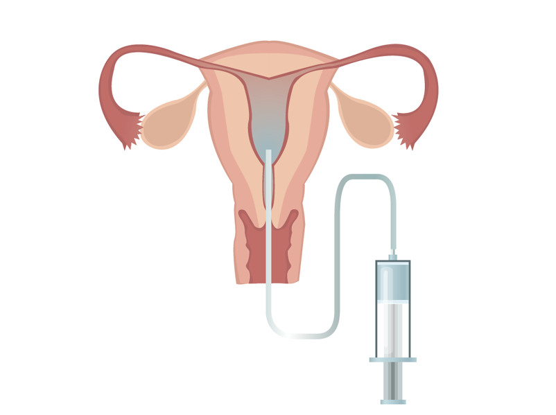 子宮卵管造影検査