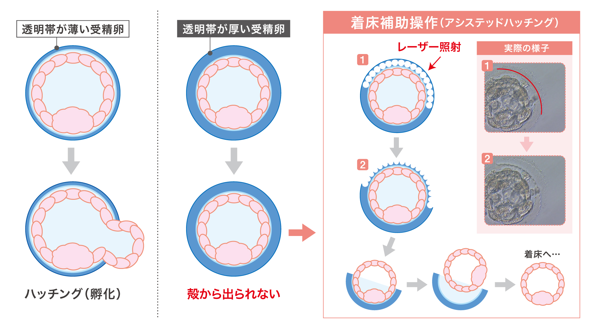 着床補助操作(アシストハッチング)