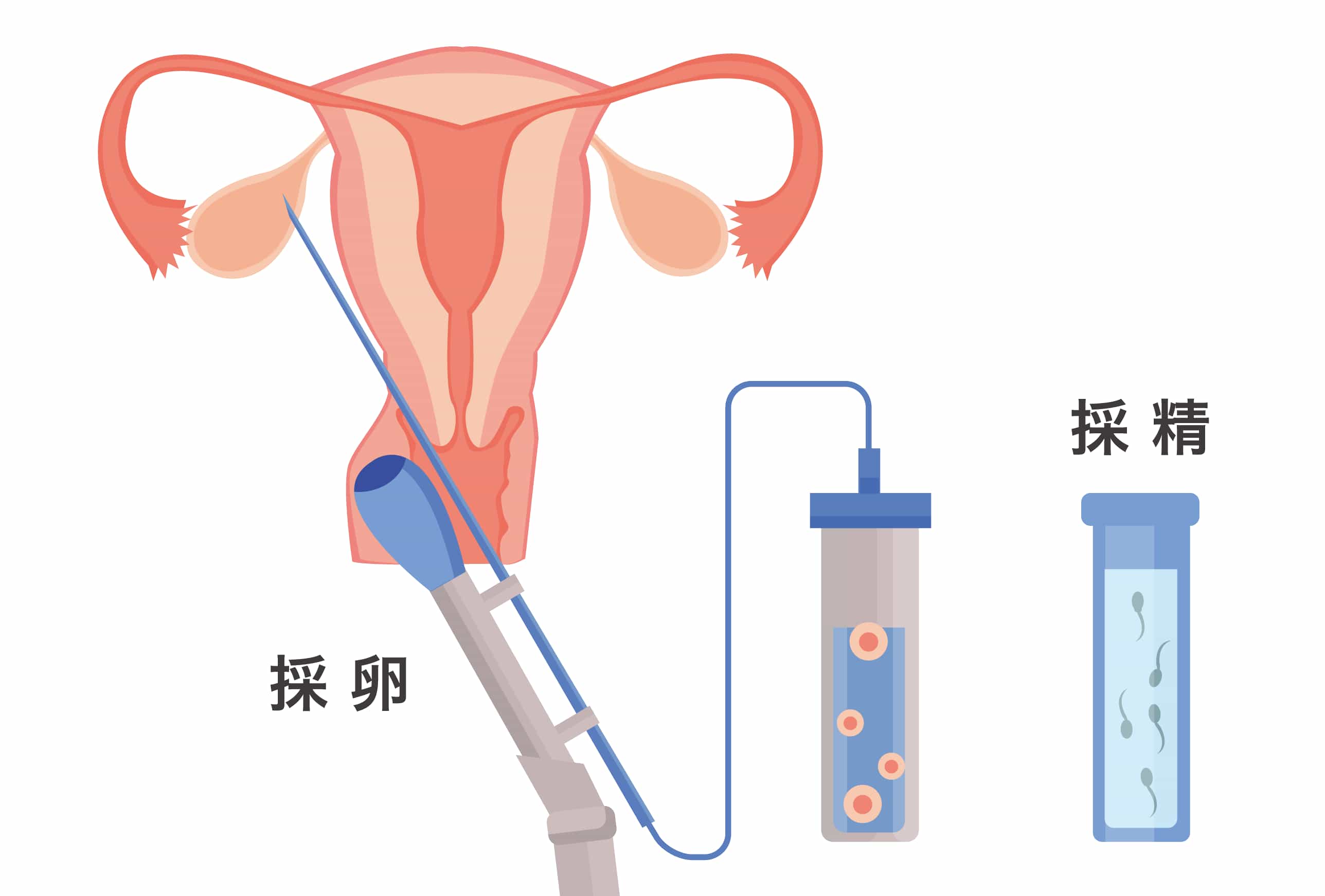 採卵