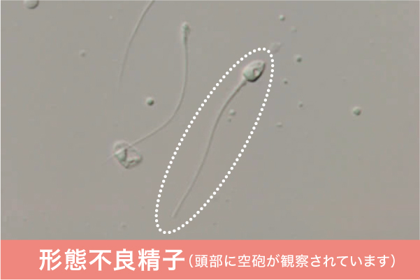 不良精子